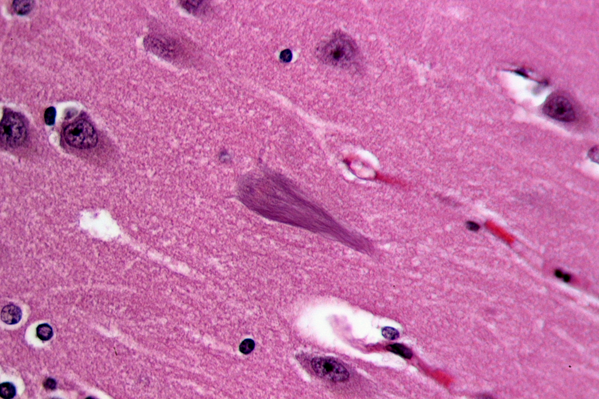 Komórki mózgu pacjenta z chorobą Alzheimera, linie po środku obrazu to splątane białka tau. Nowe badania w chorobie Alzheimera sugerują, że splątane tau może przeskakiwać z jednej komórki mózgu do innej.