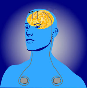 Głęboka stymulacja mózgu polega na włożeniu do mózgu cienkich elektrod. Impulsy elektryczne dostarczają generatory  umieszczone pod skórą  
