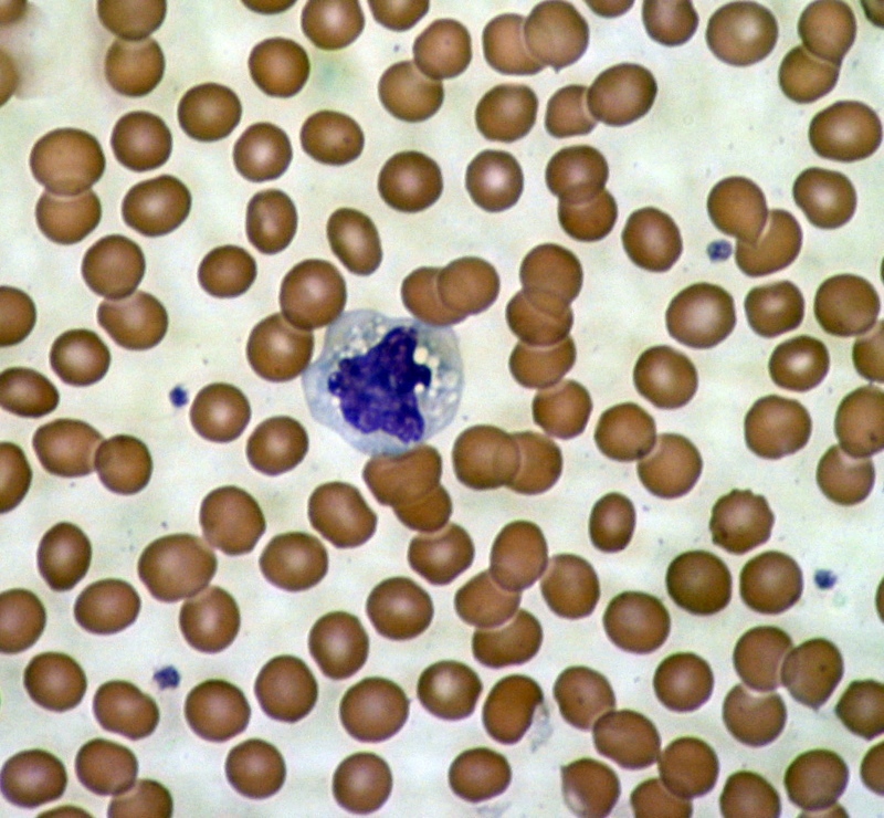 Mikroskopowy obraz krwinek - erytrocyty (czerwone krwinki) otaczają pojedynczą komórkę układu odpornościowego.  