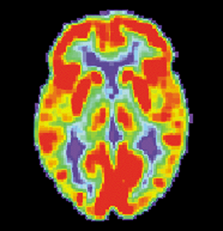 Skany FDG-PET pozwalają zobaczyć ile cukru zużywają poszczególne regiony mózgu. To skan zdrowego mózgu. Czerwone obszary zużywają najwięcej cukru.  